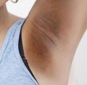 ครีมทารักแร้ขาว