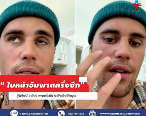 โรคใบหน้าอัมพาตครึ่งซีกคืออะไร?