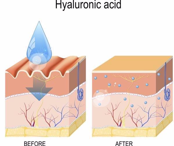 hyaluronic acid