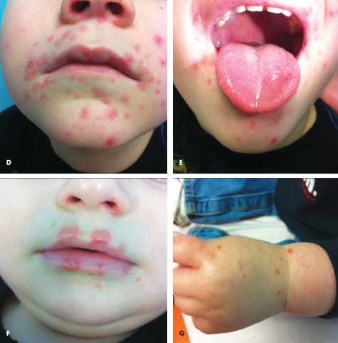 Hand, foot and mouth disease