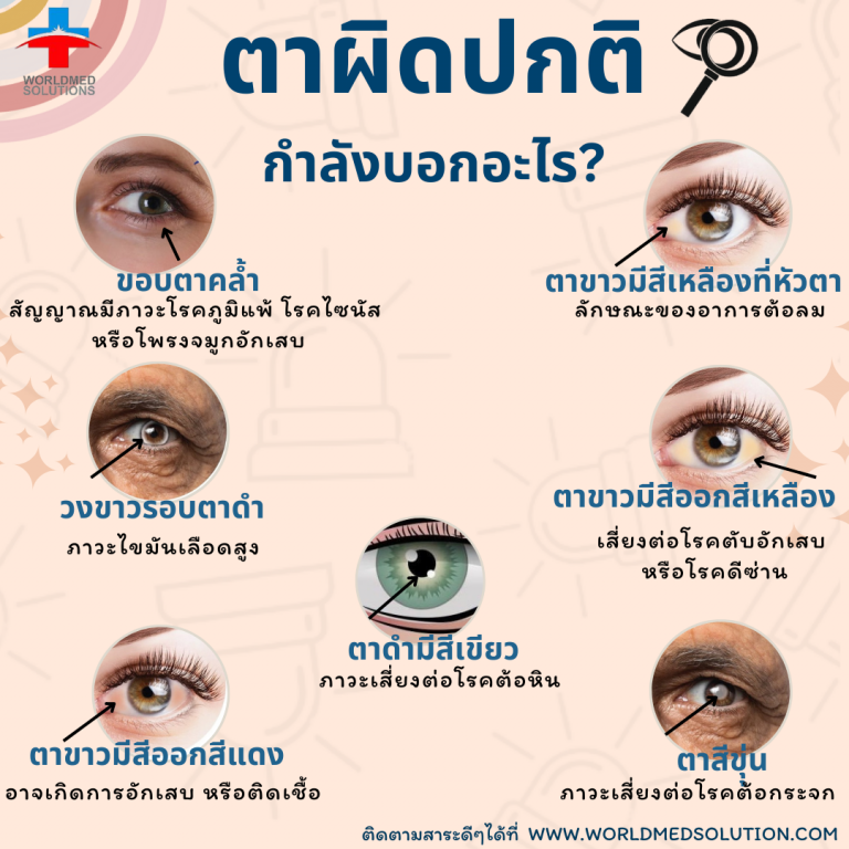 ตาผิดปกติ กำลังบอกอะไร