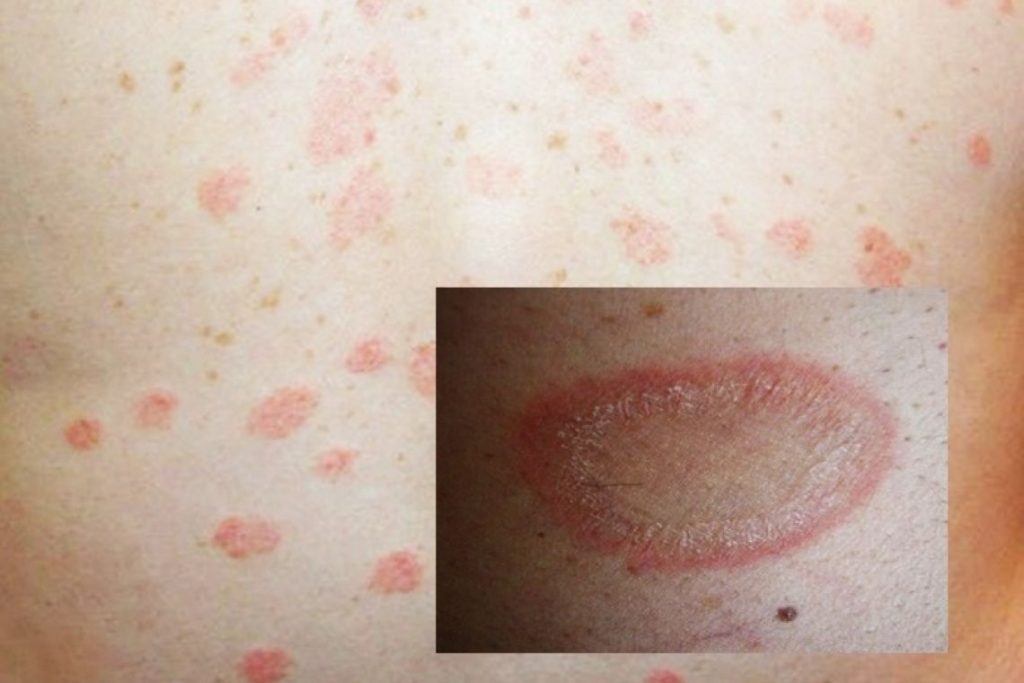 ผื่นกุหลาบ