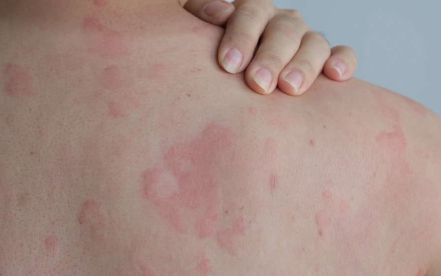 ผื่นหลังคลอด