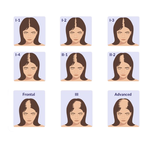 ผมร่วงหลังคลอด